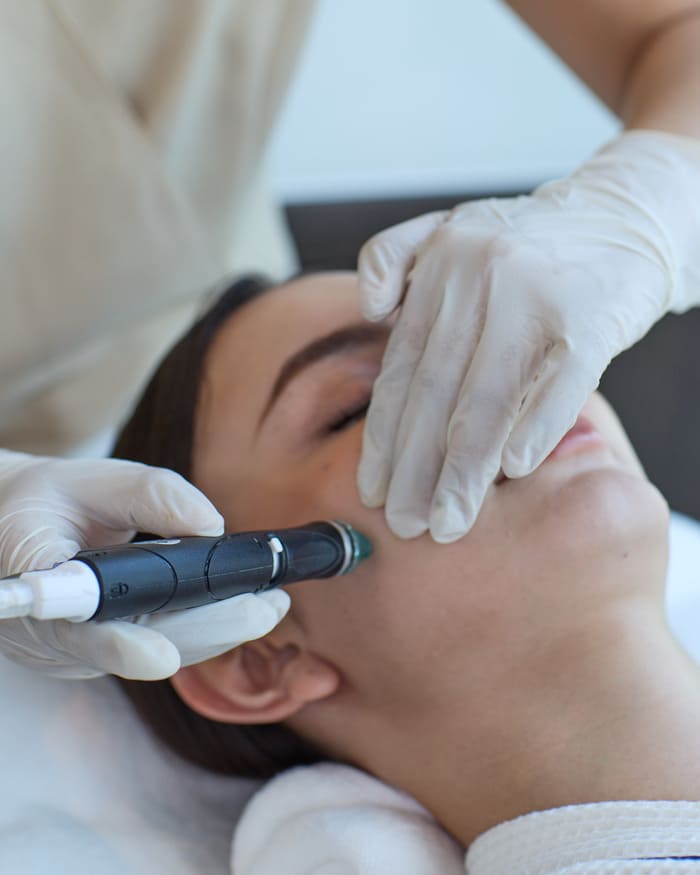 Understanding Chemical Peels: A Controlled Renewal Process